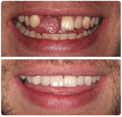 before and after low cost dental implants in Doncaster