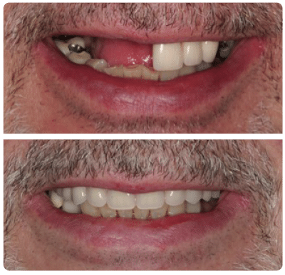 results from dental implant clinic Yorkshire Edlington Dental