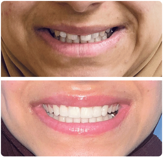 Invisalign in Doncaster by Edlington Dental